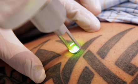 Pearl Plastic Surgery Clinic Mandaveli - Rs 19 to get 30% off on tattoo removal services