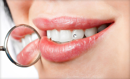 Suraksha Dental Hospital Himayat Nagar - Get 50% off on tooth jewellery. Also get 10% off on laser tooth whitening!