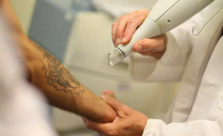 Dr Talwar's Skin Hair And Laser Clinic Sector 34 - 30% off on tattoo removal treatment. No more regretting over a tattoo!