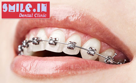 Smile.In Kandivali - Upto 30% off on dental treatments. Get the perfect smile!