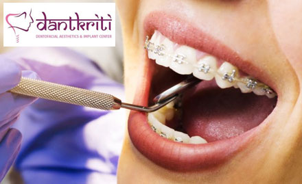 DantKriti Sushant Lok Phase 1, Gurgaon - Get 30% off on Zirconia crowns, dental braces, veneers & more! 